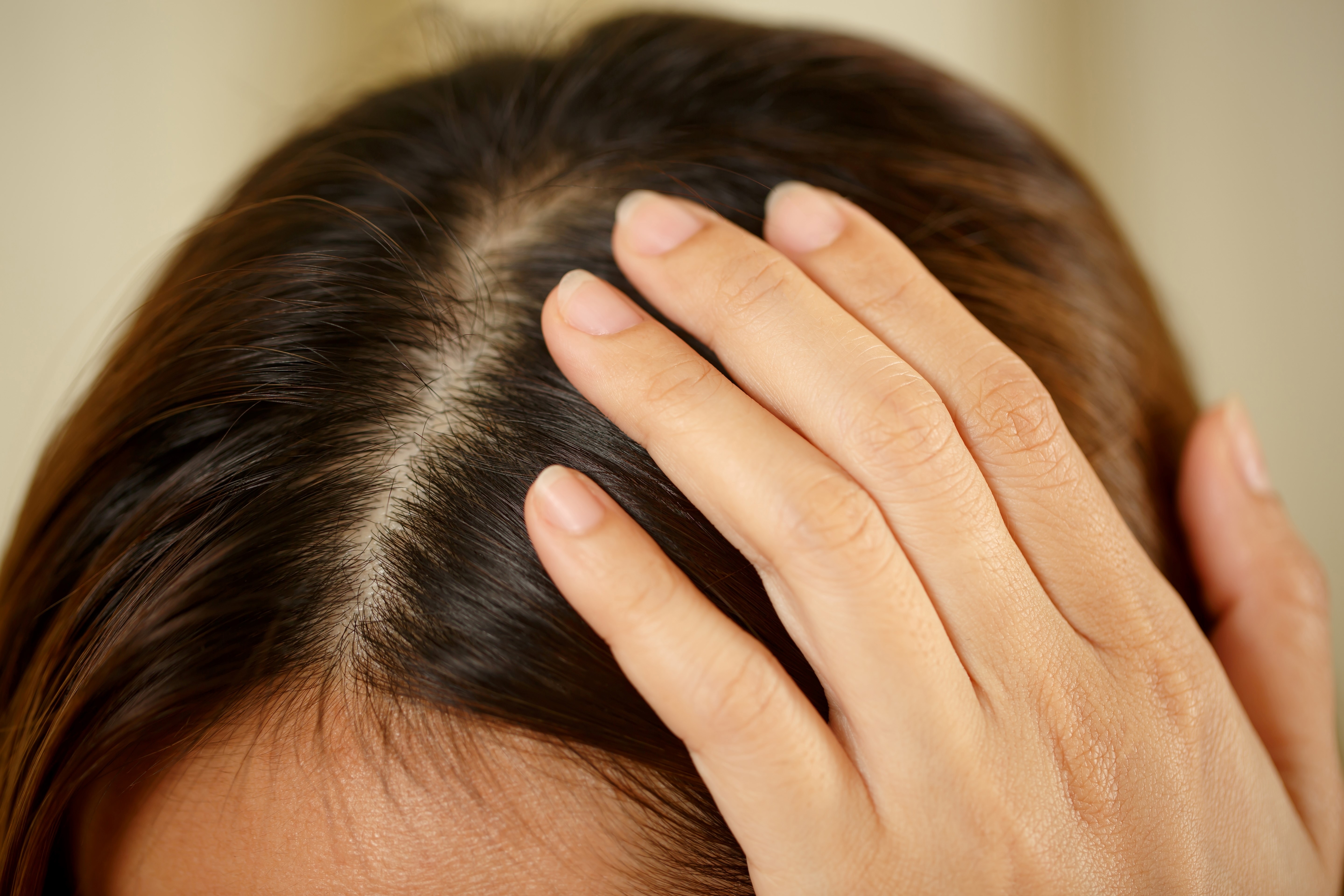 Psoriasis du cuir chevelu : comment le reconnaitre ?